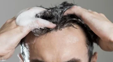 قشرة الرأس في الشتاء 3 عوامل خفية تزيد نمو فطريات فروة الرأس وكيفية الوقاية منها 1